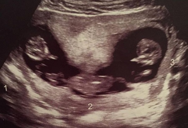 40 Trillizos Idénticos 20