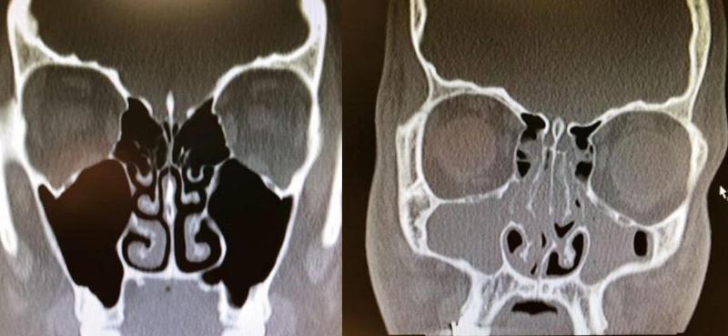 congested and uncongested xray