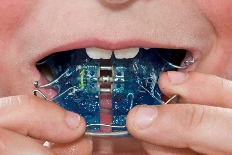 boy-putting-on-orthodontic-braces.-91723