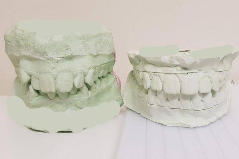 before and after braces fix