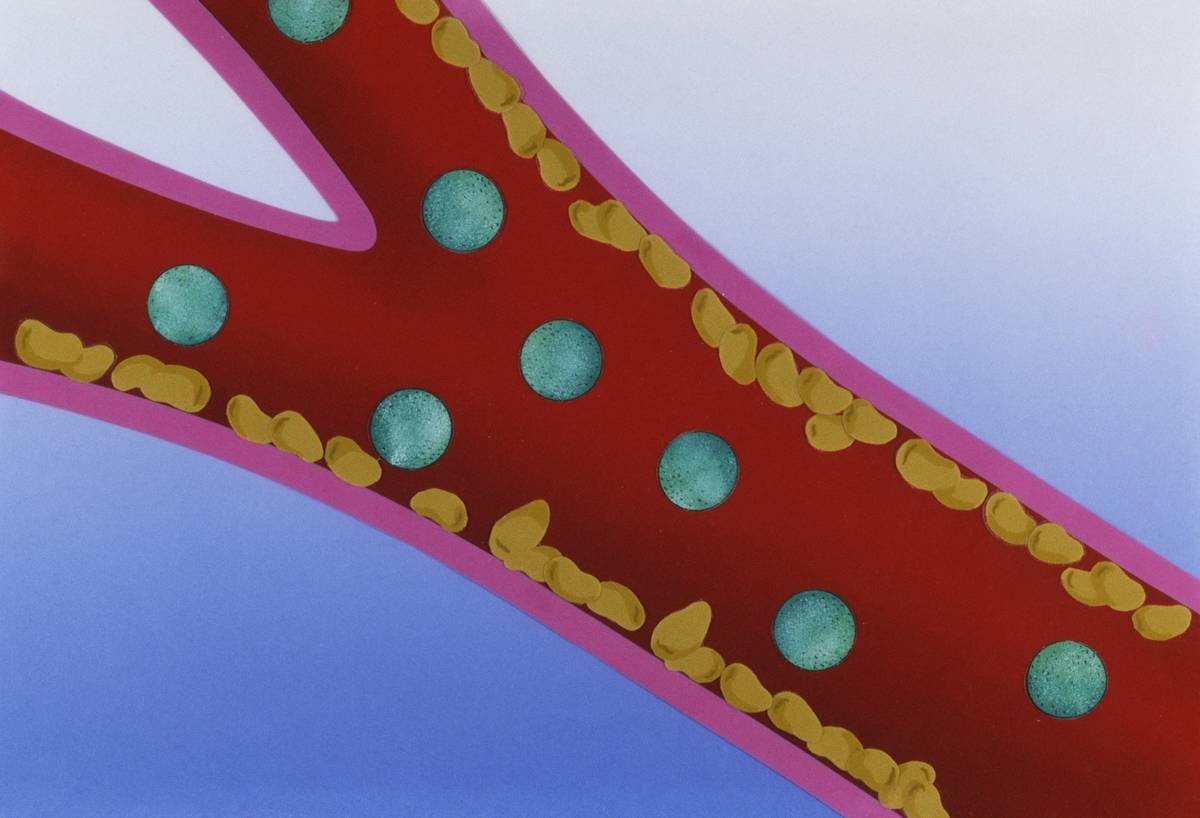 Circulatory system, artery with LDL lipoprotein and cholesterol, drawing