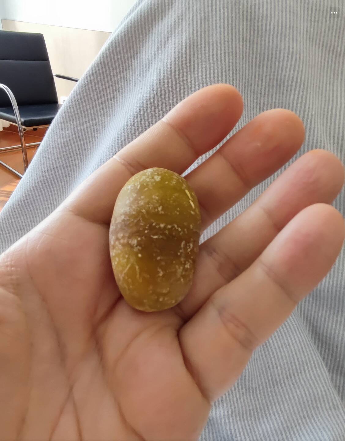 gallstone